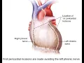 Pericardiotomy CPT code - simplify medical coding