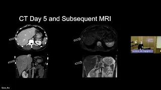 NEJM Case Records of the MGH A 28-year-old man with headache and vision loss affecting the right eye