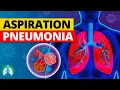 Aspiration Pneumonia Medical Definition Quick Explainer