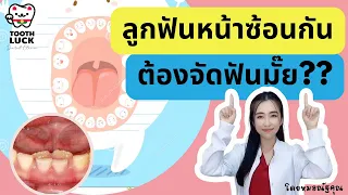  ฟันแท้ซ้อนกันอยู่ด้านในของฟันน้ำนม ควรทำอย่างไรบ้าง 