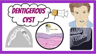 ORAL PATHOLOGY DENTIGEROUS CYST