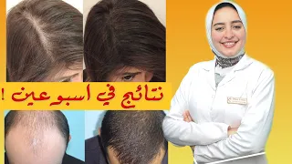 اقوي تركيبه لعلاج تساقط الشعر وانبات شعر فالفراغات في اسبوعين فقط 
