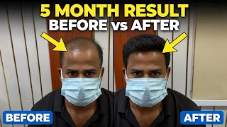 5 Month Results / Hair Transplant Results / 22k views