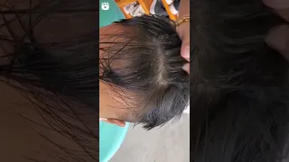 خطيير انظر ماذا فعل القمل لشعر هذه الفتاة  خطيير انظر ماذا فعل القمل لشعر هذه الفتاة