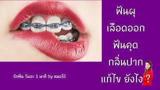 สาเหตุที่ผู้จัดฟันมีแนวโน้มเกิดเหงือกอักเสบ หรือฟันผุได้ง่ายกว่าคนทั่วไปคืออะไร