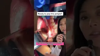 Huge Puss Filled Tooth Infection Infection Dentist Pimplepopper 