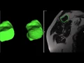 vtkClipClosedSurface and vtkClipPolyData