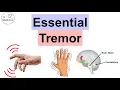 Download Lagu Essential Tremor | Causes, Pathophysiology, Symptoms, Exacerbating Factors, Diagnosis, Treatment