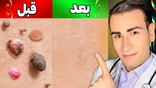 از بین بردن یک روزه زگیل و منگوله های پوستی در خانه                                دندنها