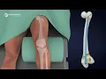 Mastering the RFN Retrograde Femoral Nailing System Surgical Technique Animation
