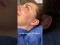Earlobe Repair