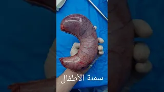 اجراء التكميم لطفلة عمرها ١١ سنة   سمنة الأطفال دندنها