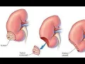 Nephrotomy CPT codes - simplify medical coding