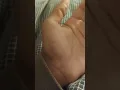 Benign fasciculation syndrome BFS in thumb muscle