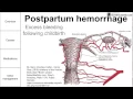 Postpartum hemorrhage