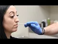 Lip Injection with Restylane Kysse