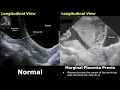 Obstetric Ultrasound Normal Pregnancy Vs Placenta Previa Low-Lying Marginal Partial Complete