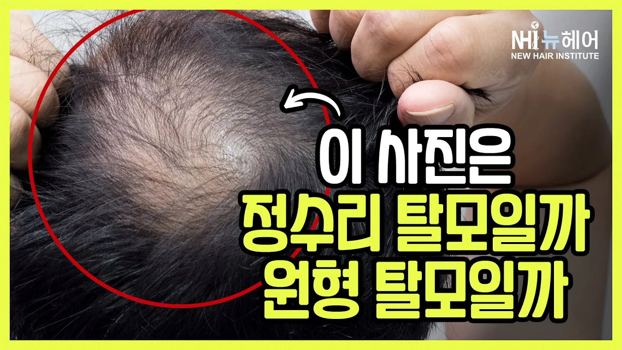 이 사진은 정수리 탈모일까 원형 탈모일까 - 뉴헤어 I 탈모치료