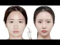 Lagu [💉] zygoma \u0026 square jaw reduction ୨ৎ