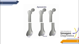 Imagenología del Sistema Músculoesquelético: Fracturas