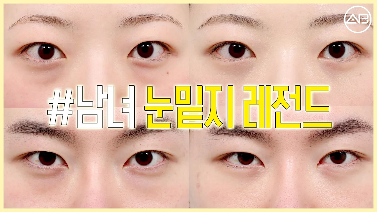 눈밑지방재배치 하나로 깨끗해진 첫인상✨ 남녀 전후 공개 | 에이비성형외과