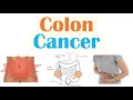 Colon Cancer CRC Risk Factors Pathogenesis Symptoms Diagnosis Staging Treatment