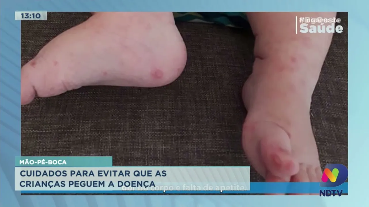 Mão-pé-boca: saiba os cuidados para evitar que as crianças peguem a doença