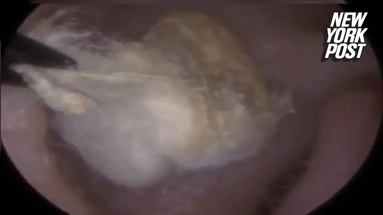 LINK OF MY NEW PIMPLE POPPING CHANNEL AND NOW I WILL UPLOAD MY ALL EXTRACTION VIDEOS ON THIS CHANNEL. 