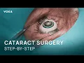 Cataract Surgery Explained in 3D Phacoemulsification Step-by-Step