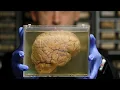 What Happened To Ted Bundy s Brain After His Execution