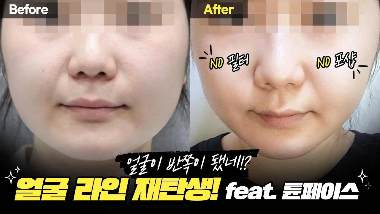 이중턱, 심부볼 가득했던 얼굴 #튠페이스 후 30일 모습은? 찐 real 후기