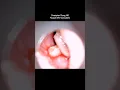 Download Lagu MAGGOTS in the Ear Canal (Myiasis)