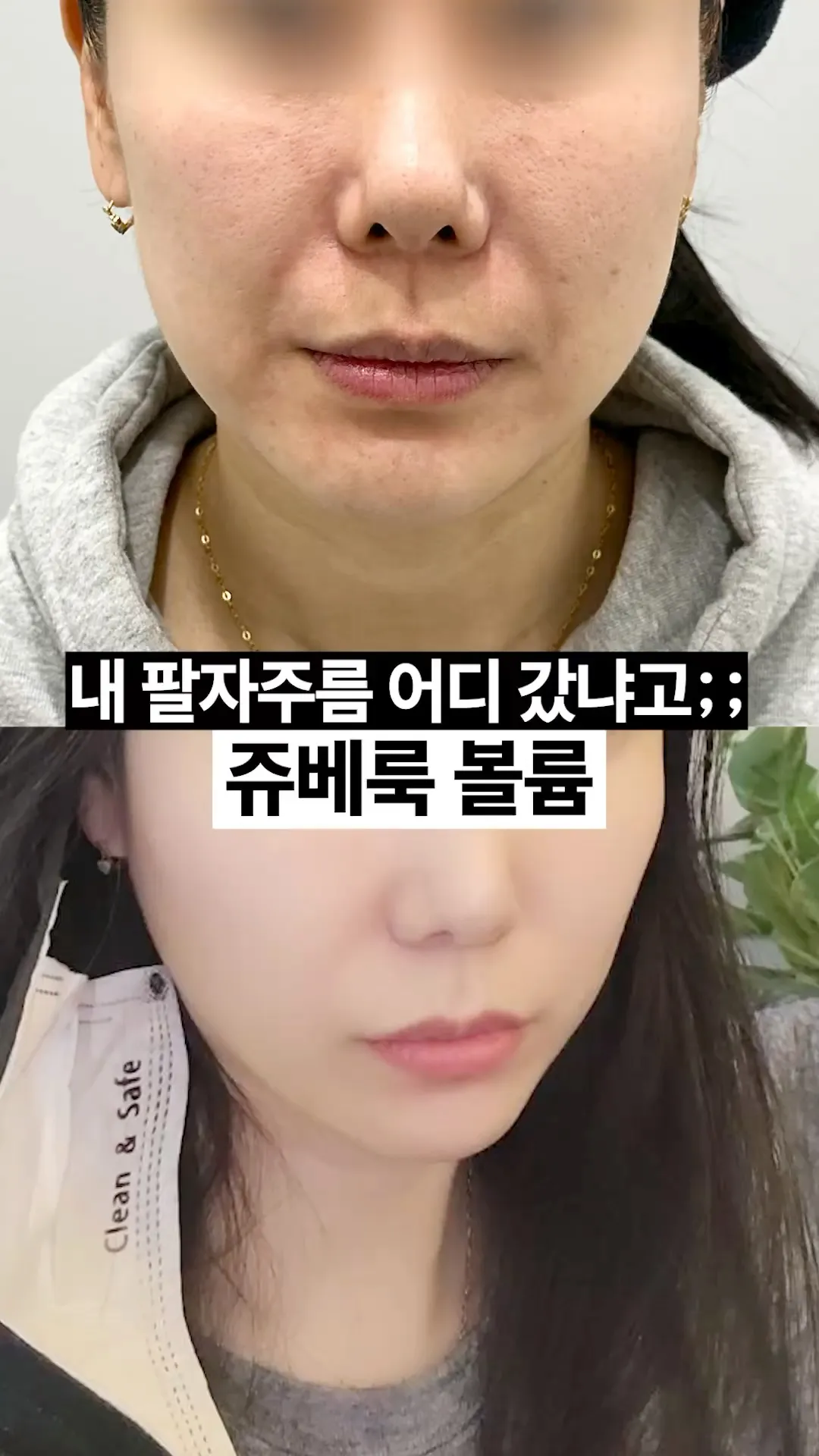 팔자주름 다림질한 후기😖