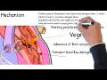 Download Lagu Infective Endocarditis -  simply explained. Symptoms, signs, causes