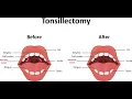 Tonsillectomy CPT code - simplify medical coding