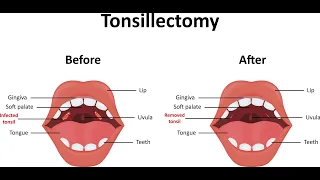 Tonsillectomy CPT code - simplify medical coding