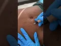 Stretch Marks Inkless Removal Boleyn Treatment Los Angeles