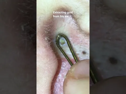 Extracting gold from his ear
