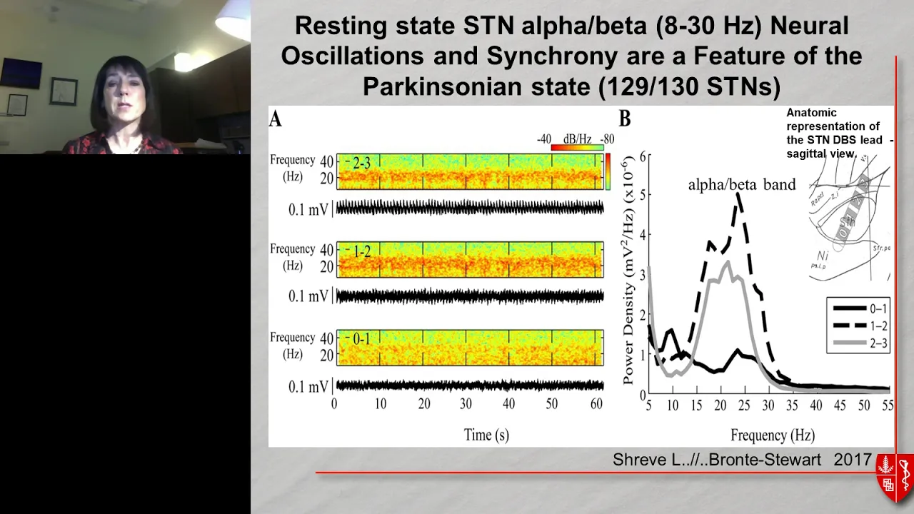 Clinical Updates: Closed Loop Deep Brain Stimulation in Parkinson's Disease Using..