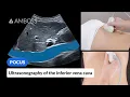 Point of Care Ultrasound of the Inferior Vena Cava IVC - AMBOSS