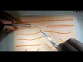 Suture Removal