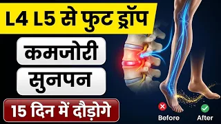 L4 L5 S1 के कारण फुट ड्रॉप| Best Exercises For Foot Drop