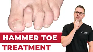 claw toe u0026 hammer toe treatment straighten your toes no surgery 