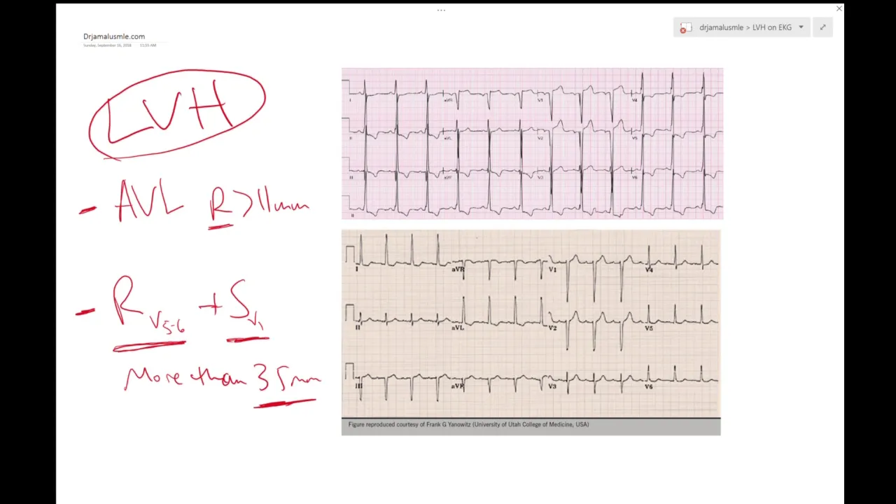 LVH on ECG (Left ventricular hypertrophy) - Learn ECG! - Dr Jamal USMLE