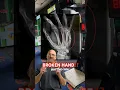 Boxer s Fracture Complications