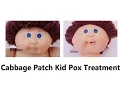 Cabbage Patch Kid Pox Treatment Process