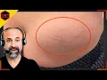 How to Avoid Testosterone Injection Site Swelling or Lumps