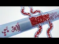 AI-Based CTA Tool for Anterior Circulation Large Vessel Occlusion Detection
