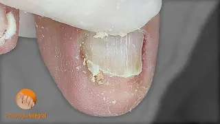 Subungual onychomycosis + onychophosis (callus in the groove of the toe) | Podología Integral