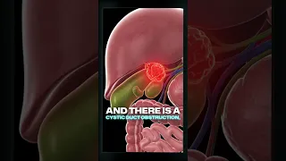 Understanding the HIDA Scan Evaluating Gallbladder and Bile Duct Function